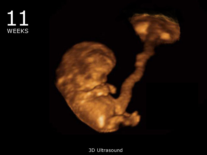11 week ultrasound 3D