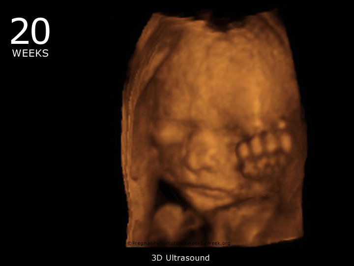 twin 3d ultrasound 20 weeks