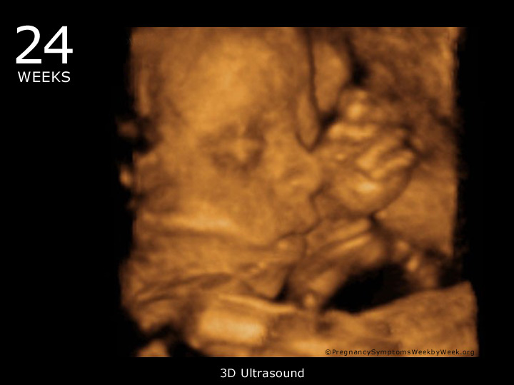 24 weeks fetus in womb